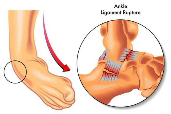 Fix Ankle Sprains Forever