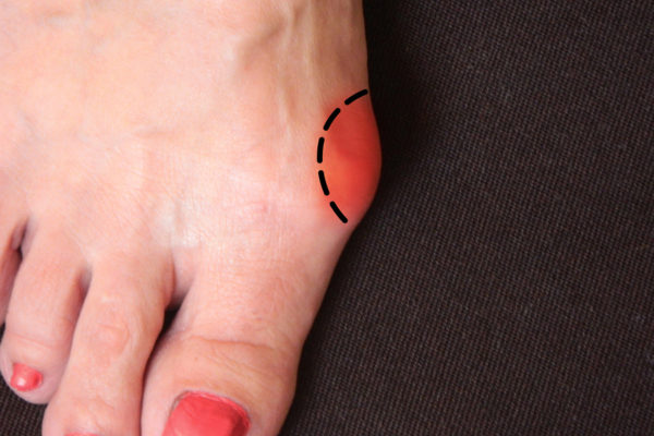 Surgical Highlight: Bunions
