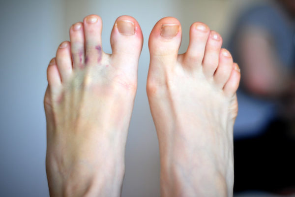What Are COVID Toes & How Are They Treated?