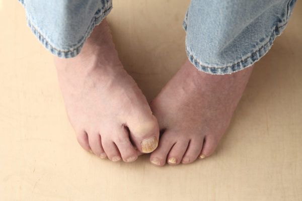 Get Rid of Toenail Fungus: The Podiatrist’s Guide