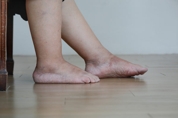 The Truth About Leg Swelling