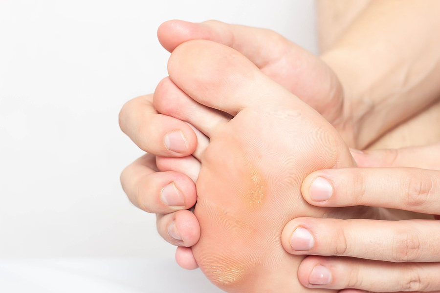 Why Calluses Are Bad News for Diabetics