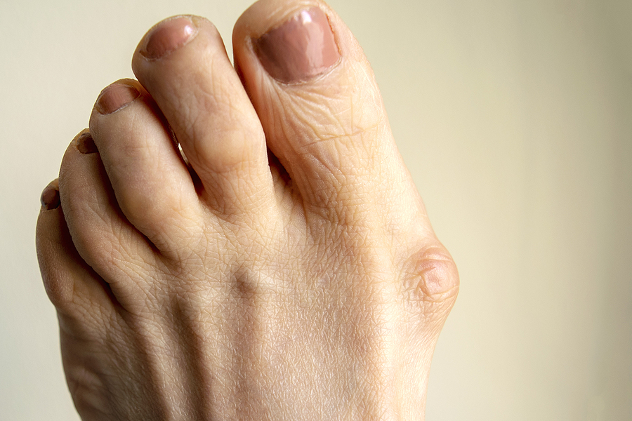 Preventing Bunions