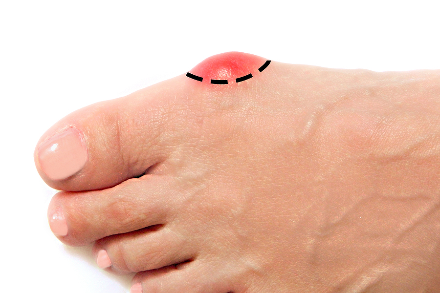 Can I Wait for Bunion Surgery?