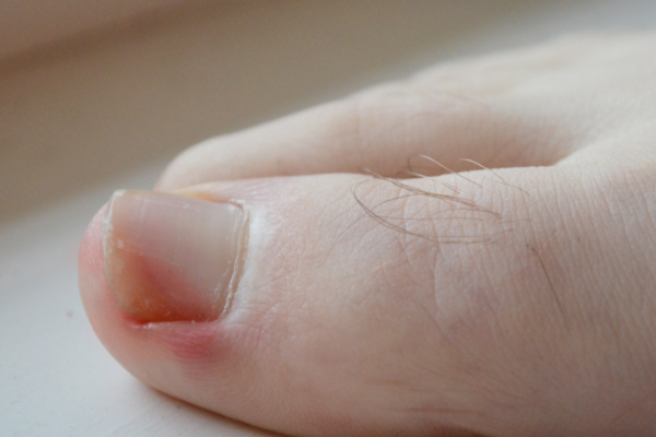 “I’m Sure This Will Go Away” and Other Myths about Ingrown Toenails