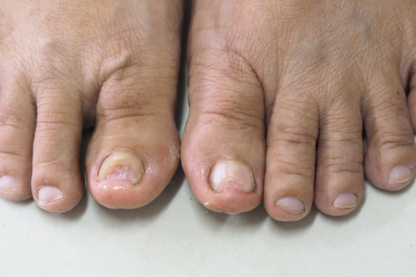 5 Myths About Ingrown Toenails