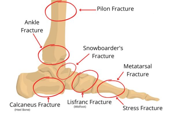 BREAK-ing Down Foot & Ankle Fractures